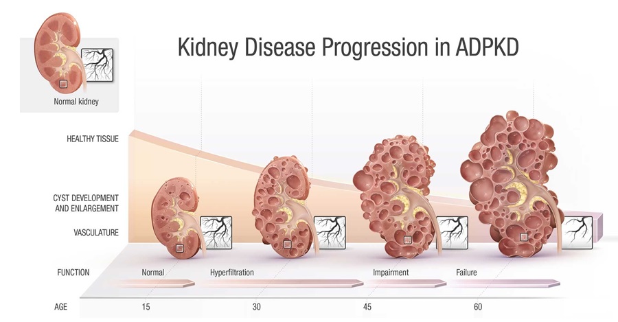 Kidney Disease Progression